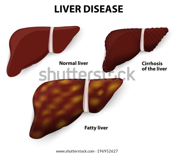 Liver Disease Cirrhosis Liver Fatty Liver Stock Vector (Royalty Free ...