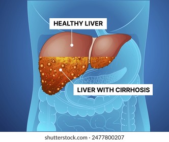 Liver disease. Cirrhosis of the liver. Healthcare illustration. Vector illustration.