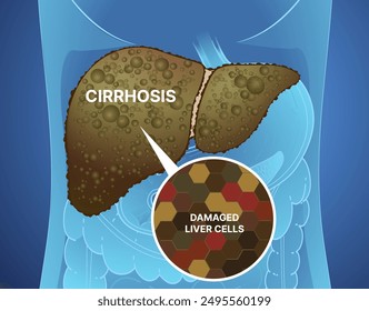 Liver disease. Cirrhosis of the liver. Healthcare illustration. Vector illustration.