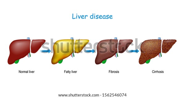 Liver Disease Healthy Internal Organ Fatty Stock Vector (Royalty Free ...