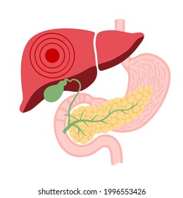 Logo für Lebererkrankungen. Fibrose, Zirrhose, Fettleber oder Krebskonzept. Schmerzen, Tumor oder Beschädigung beim Konzept des menschlichen Verdauungssystems. Gallenblase, Magen und Bauchspeicheldrüse anatomische flache Vektorgrafik.