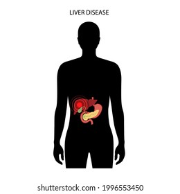 Liver disease logo. Fibrosis, cirrhosis, fatty liver or cancer concept. Pain, tumor or damage in man silhouette. Digestive system problem. Gallbladder, stomach and pancreas medical vector illustration