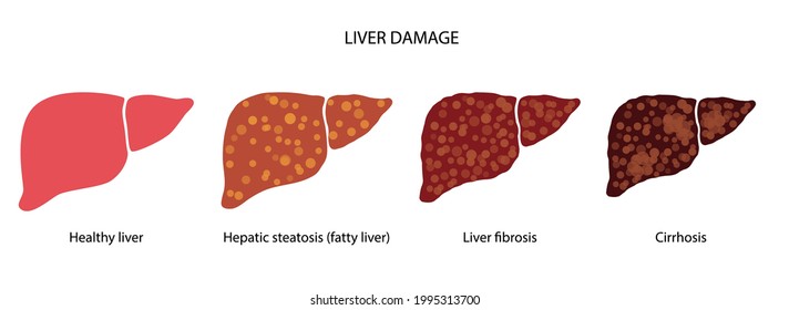 Liver Disease Logo Healthy Organ Fibrosis Stock Vector (Royalty Free ...