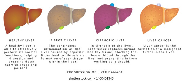 Liver Disease Stages Liver Damage Liver Stock Vector (Royalty Free ...