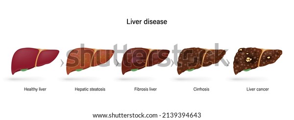 Liver Disease Stages Liver Damage Healthy Stock Vector (Royalty Free ...