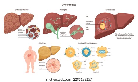 Enfermedades hepáticas. Patología de órganos del sistema hepático. Daño hepático, grasa, absceso y cirrosis. Tipos de virus de la hepatitis. Ilustración vectorial plana.