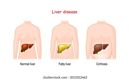 Liver diseases. Stages of liver damage. Healthy, fatty,  and cirrhosis. human body with illuminated healthy and diseased internal organs. Vector illustration