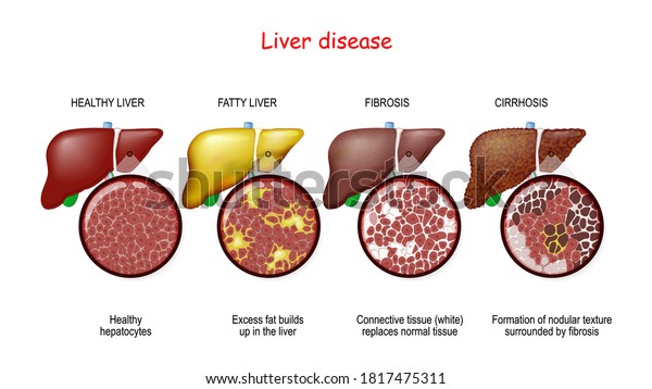 Liver Diseases Stages Liver Damage Healthy Stock Vector (Royalty Free ...