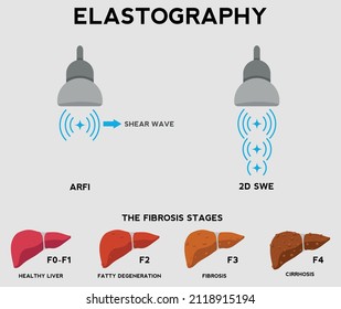 Liver Elastography. Stages Of Liver Fibrosis