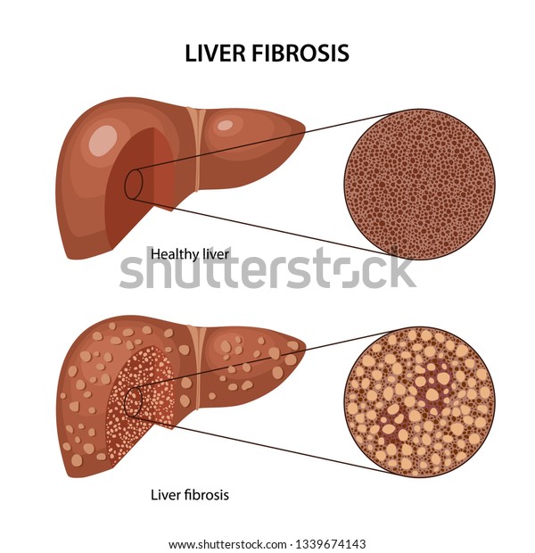 Liver Fibrosis Histology Healthy Fibrous Liver Stock Vector (Royalty ...