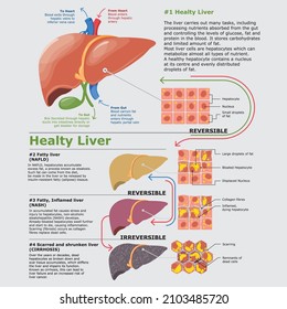 Liver Health Stages Fatty Inflamed Scarred And Shrunken