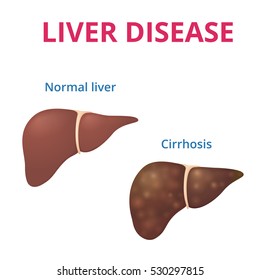 1,567 Normal Liver Images, Stock Photos & Vectors | Shutterstock