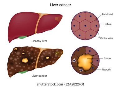 Liver Histology Normal Liver Liver Cancer Stock Vector (Royalty Free ...