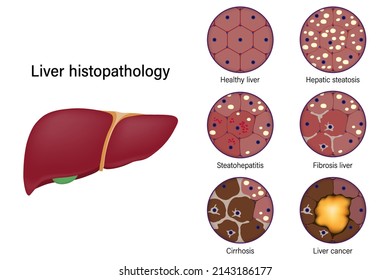 Liver histopathology. Healthy liver, Hepatic steatosis, Steatohepatitis, Fibrosis liver, Cirrhosis and Liver cancer.