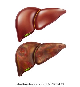 Liver Human Healthy And Unhealthy Organ Set Vector. Liver Health Research Health And Disease, Cirrhosis And Cancer, Gastric, Hepatitis And Inflammation. Template Realistic 3d Illustrations