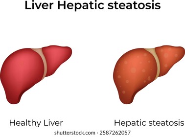 Liver Steatosis Comparison Design Vector Illustration