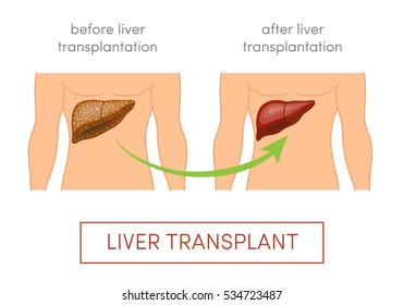 Liver Transplant Vector Concept