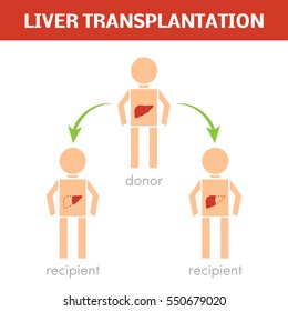 Liver transplantation vector concept
