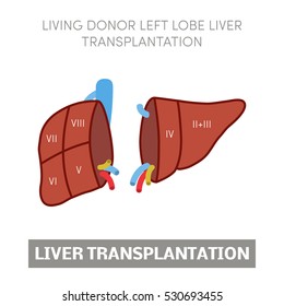 Living donor left lobe liver transplantation, vector