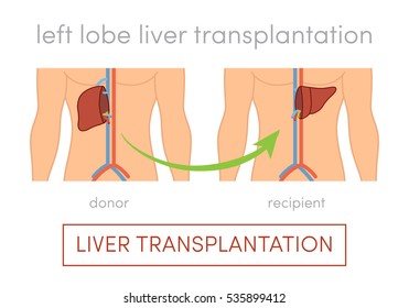 Living donor left lobe liver transplantation vector concept