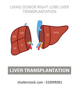 Living Donor Right Lobe Liver Transplantation, Vector