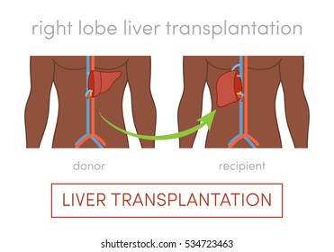 Living donor right lobe liver transplantation vector concept