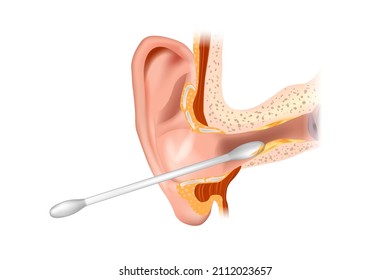 llustration of the ear canal being cleaned with a cotton swab. Section of the ear with the cerumen. Removing earwax and wrong way of using cotton swab.