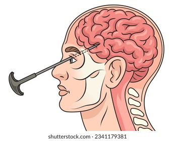 Lobotomy leucotomy neurosurgical treatment in brain diagram schematic vector illustration. Medical science educational illustration