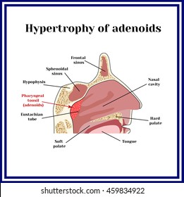 Location of adenoids.The structure of the nasopharynx. Hypertrophy of adenoid.