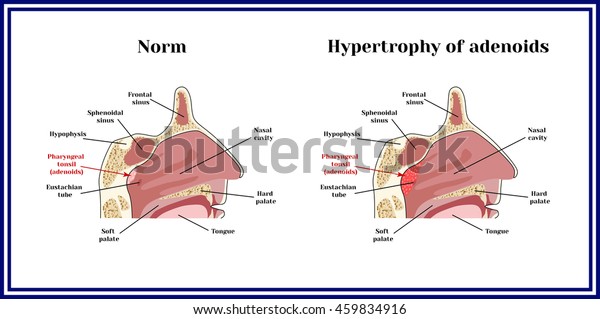 Location Adenoids Structure Nasopharynx Norm Hypertrophy Stock Vector ...