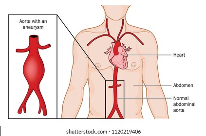 Location and appearance of an abdominal aortic aneurysm