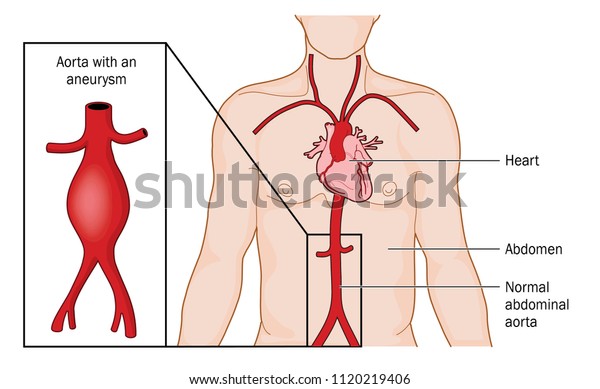 Location\
and appearance of an abdominal aortic\
aneurysm