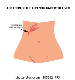 Location of the appendix under the liver. The appendix under the liver. Infographics. Vector illustration on isolated background.