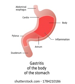 Antral Location Gastritis Inflammation Lining Stomach Stock Vector ...