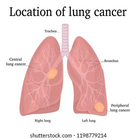 Comparison Between Healthy Lung Cancer Lung Stock Vector (Royalty Free ...