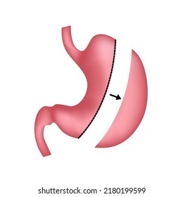 Longitudinal Resection Of The Stomach. Treatment Of Obesity With Surgery. Vector Illustration