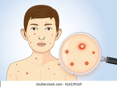 Looking rash of children which has symptoms of chickenpox with magnifier. This illustration about disease diagnose 