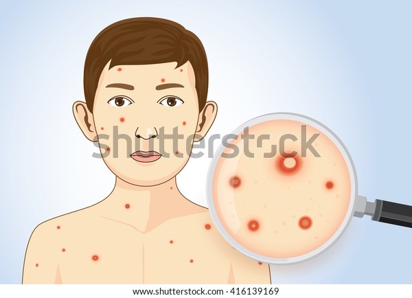 拡大鏡で水疱瘡の症状が出た子供の発疹を見た病気の診断に関するこの図 