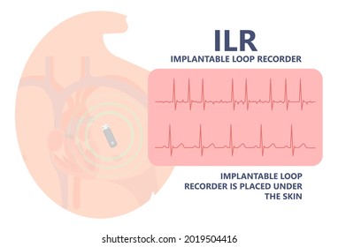 Loop Holter Event Atrial Heart Attack Stroke ECG EKG Device Monitoring Rhythm Cardiac Chest Risk ILR Implantation ICD Atrial Rate Beat Pain Artery Pulse	