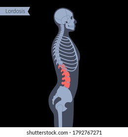 Lordosis In Human Body. Scoliosis XRay Flat Vector Illustration. Spine, Backbone, Joint And Skeleton Anatomy In Man Silhouette. Orthopedic Poster. Medical Banner. Exam In Spinal Pain Center, Clinic