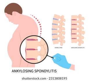 lordosis scoliosis kyphoscoliosis disease in axial ankylosing spondylitis osteoporosis and fused spine disk of kyphosis the skeletal pelvis stiffness with chronic knee ankle spondylolysis