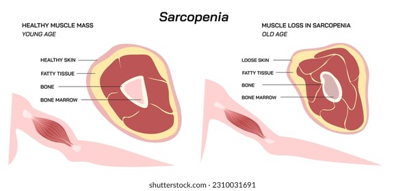 Pérdida de la masa muscular y de la fuerza Sarcopenia ilustración vectorial. Diferencia entre la masa muscular de la edad temprana y la masa muscular de la edad avanzada. 