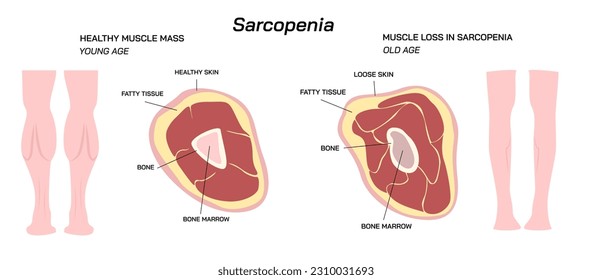 Pérdida de la masa muscular y de la fuerza Sarcopenia ilustración vectorial. Diferencia entre la masa muscular de la edad temprana y la masa muscular de la edad avanzada. 