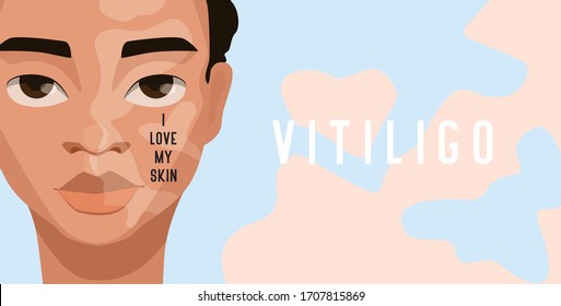 I love my skin. 25 June World Vitiligo Day. Accepting oneself. Self love. Skin disease.
Vitiligo is a long-term skin condition characterized by patches of the skin losing their pigment.