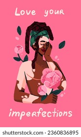 Love your body and accept imperfections concept. Happy woman with vitiligo hold flowers. Beautiful girl with blemish embraces herself. Female person care yourself postcard. Flat vector illustration