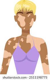 Mujer encantadora con vitiligo. Conceptos de positividad corporal en personas con enfermedad dermatológica o síndrome de vitiligo. Asistencia de personas con trastorno crónico de la piel. Ilustración vectorial