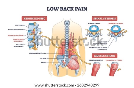 Low back pain diagram shows spine, herniated disc, spinal stenosis, and muscle strain with labeled anatomical structures. Outline diagram