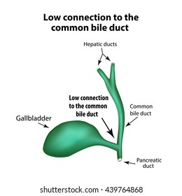 Low connection to the common bile duct. Pathology of the gallbladder. Cholecystitis. The structure of the gallbladder. Infographics. Vector illustration on isolated background.