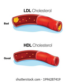 Low Density Lipoprotein And  High Density Lipoprotein Action In Blood Vessel Illustration.