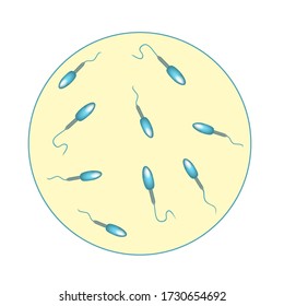 Recuento bajo de esperma en fluido seminal. Baja abundancia de esperma en el eyaculado. Infectilidad masculina Oligospermia. Spermograma. tipos de patología. Defectos espermáticos. estructura del esperma. Vector de infografía.
